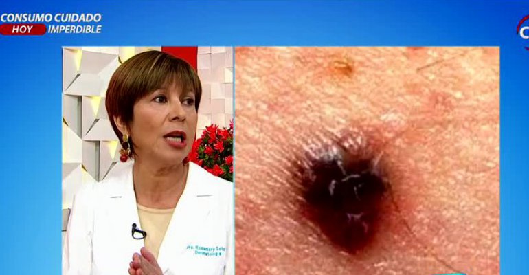 Sepa detectar cuáles son los lunares peligrosos en el cuerpo