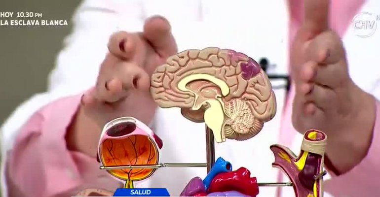 Conoce los síntomas y cómo prevenir infartos cerebrales - Parte 2