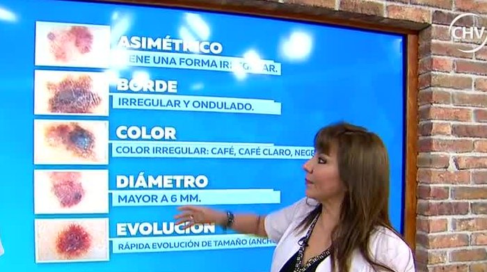 Dermatóloga explicó ¿Cómo saber si su lunar es dañino?