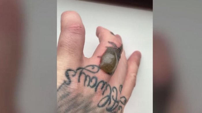 El remedio fue peor que la enfermedad: Quiso quitarse iniciales de su ex esposa tatuadas en su mano y este fue el resultado