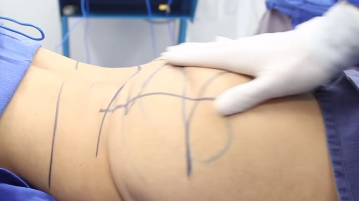 El alto costo de la belleza: Pacientes denuncian a médicos por sus fallidas cirugías plásticas