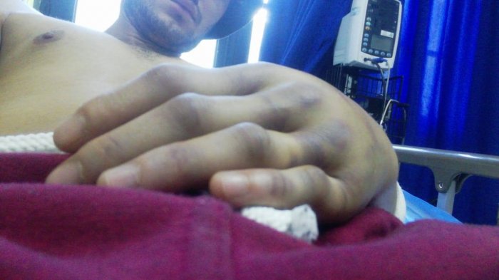 Sufrió fracturas múltiples: Denuncian brutal agresión homofóbica contra joven en el Parque Forestal