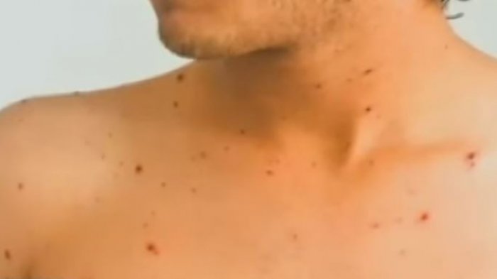 Autoridad sanitaria metropolitana confirmó segundo caso de sarampión en el país