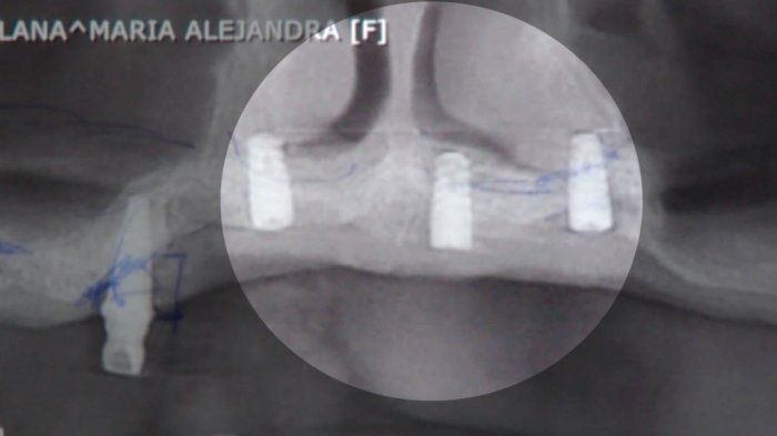Las nefastas consecuencias de los implantes dentales mal puestos