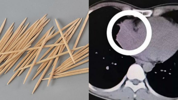 Joven vivió 4 años con un mondadientes de 6 centímetros alojado en su corazón