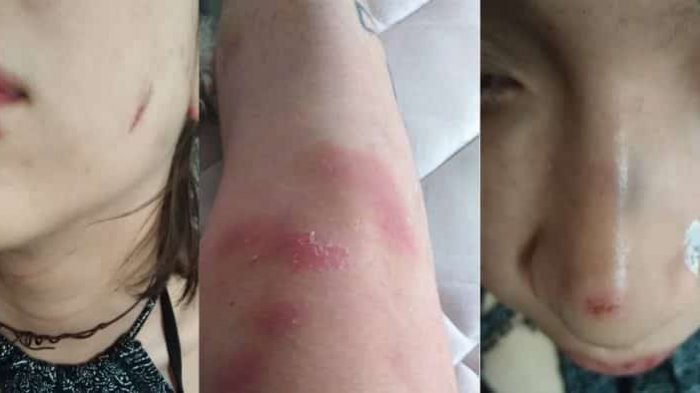 Pareja de lesbianas denuncia golpiza lesbofóbica en Bellavista: Las patearon en el suelo y azotaron en una muralla