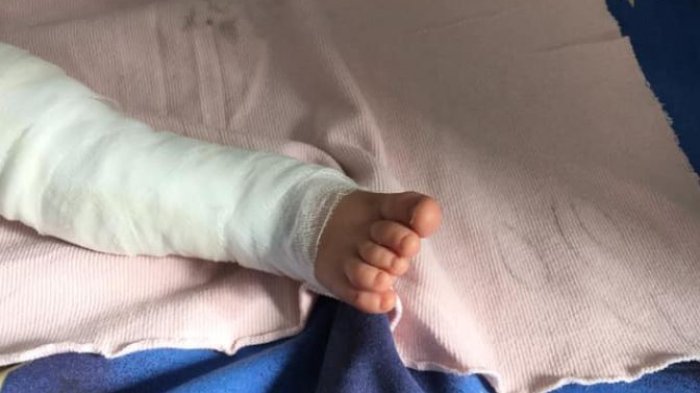 Lucha por su vida: Bebé de 11 meses cayó a un balde con agua hirviendo y resultó con el 80% de su cuerpo quemado
