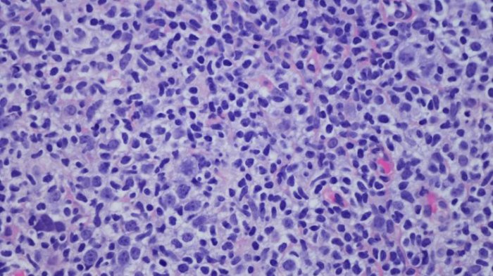 Prometedora vacuna contra el cáncer logra curar el linfoma de 3 pacientes