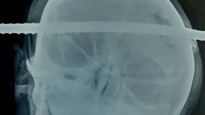 Joven obrero cayó a un pozo y un fierro le perforó la cabeza: Por milímetros se salvó de la muerte