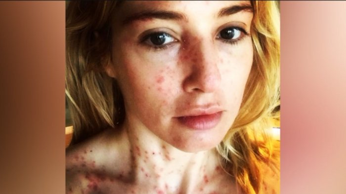 Qué es la psoriasis, la enfermedad que afecta a la actriz María Elena Swett y ataca silenciosamente