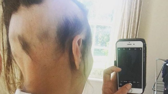 “Alopecia por estrés”: El dramático caso que afectó a una mujer después de casarse