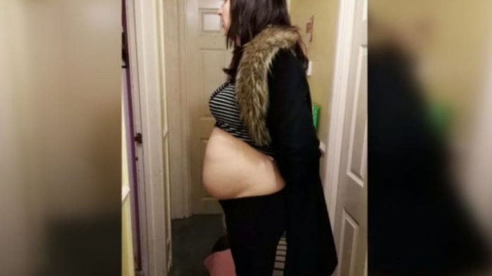 Pensó que estaba embarazada: El impactante diagnóstico de una mujer que tenía un tumor de 40 cm en su ovario