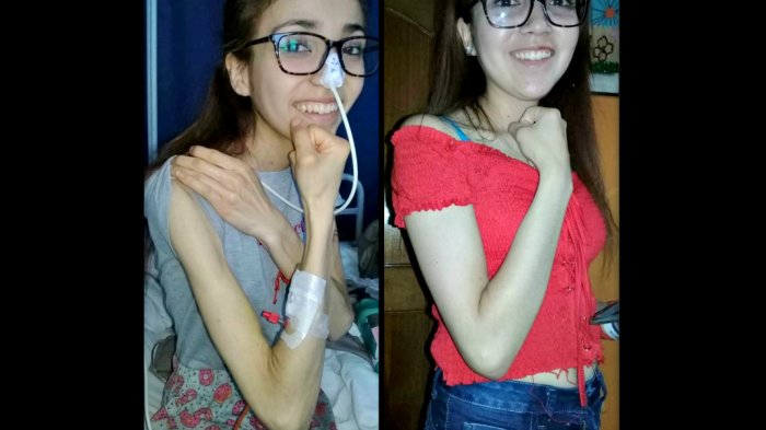 “Pesaba 27 kilos y me desmayaba en clases”: Relato de una joven anoréxica que exige que la enfermedad esté en el Auge