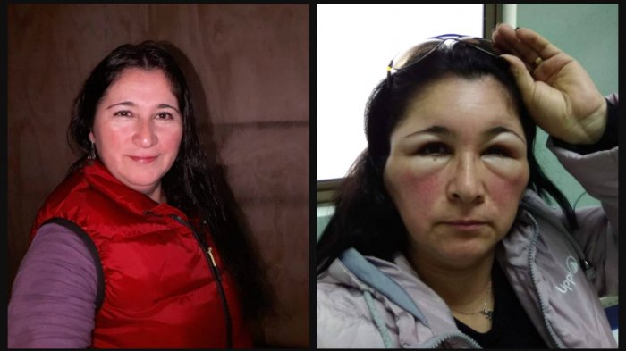 Quedó desfigurada y hospitalizada: Mujer se tiñó el pelo, pero no sabía que era alérgica al amoniaco