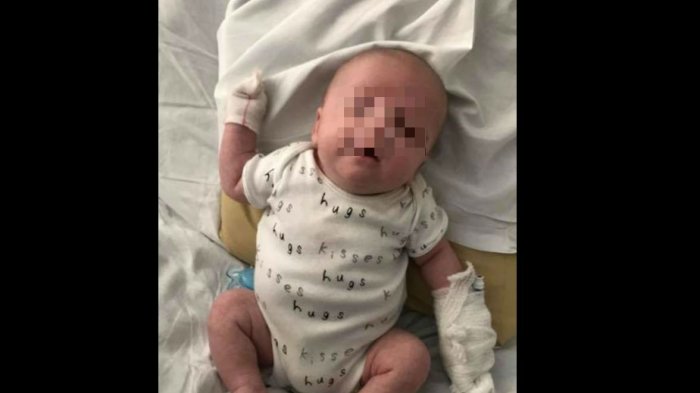 Recién nacido estuvo a punto de morir luego que un beso lo contagiara con herpes