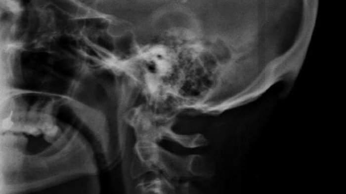 Científicos australianos analizaron radiografías y descubrieron un inédito desarrollo de cuernos en personas de 18 a 30 años