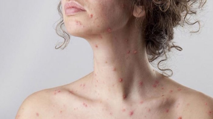 Alerta en Rancagua por caso de mujer de 44 años que contrajo sarampión