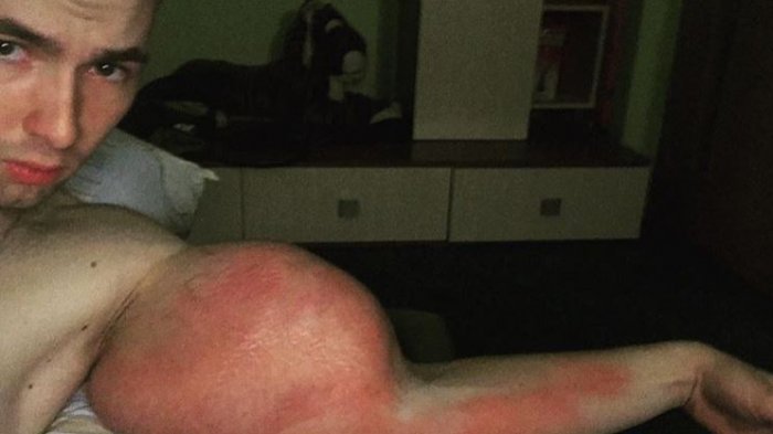 Se inyectó aceite en sus brazos para aumentar su tamaño y ahora está desesperado: Necesita una operación