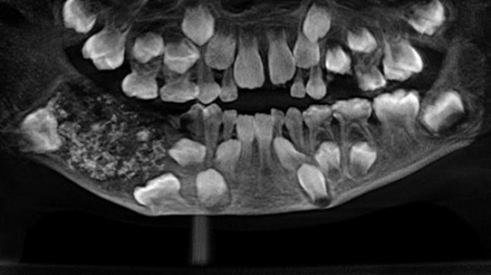 ¿Dolor de muelas?: A niño le encontraron 526 dientes alojados en su mandíbula tras visistar al dentista