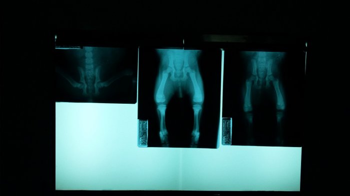 Fue a la clínica por un dolor de rodilla y descubrió que su pene se está transformando en un hueso