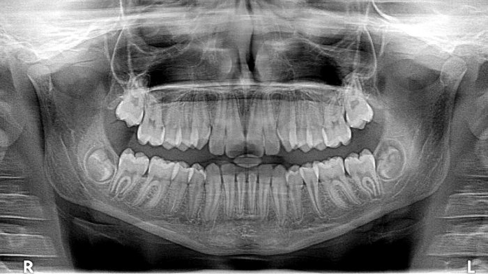 Adolescente aguantó el dolor de muela durante un año y terminó con un hoyo en su mandíbula