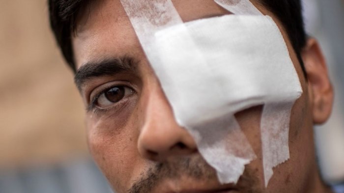 Hospital del Salvador asegura que desde el estallido social se han registrado 280 casos de trauma ocular severo