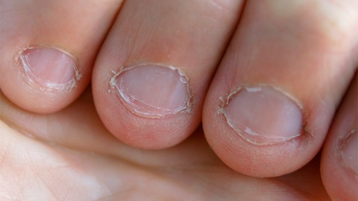 Hombre estuvo al borde de la muerte tras contraer infección por comerse reiteradamente las uñas