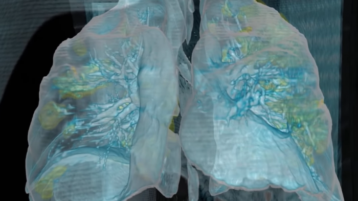 Video en 3D muestra los graves daños que provoca el coronavirus en los pulmones