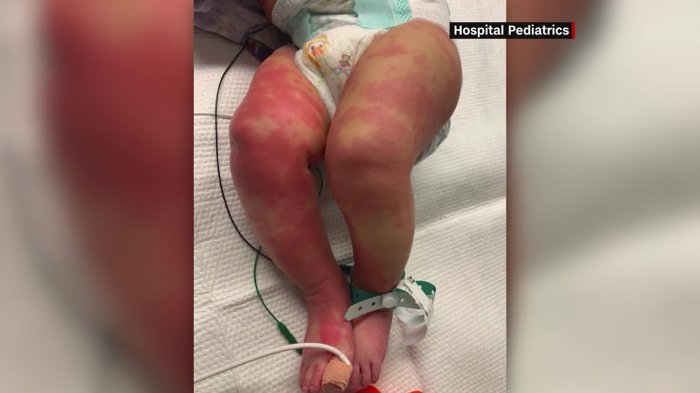 Reportan varios casos de extraña condición que afecta a los niños tras contagiarse de COVID-19