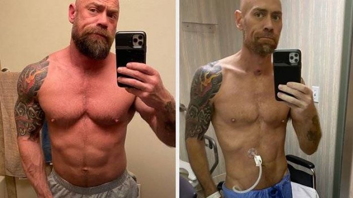 Hombre comparte el impactante cambio físico que sufrió tras contagiarse con COVID-19: 