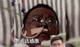 Muere doctor chino que sufrió un cambio en la pigmentación mientras era tratado por el COVID-19