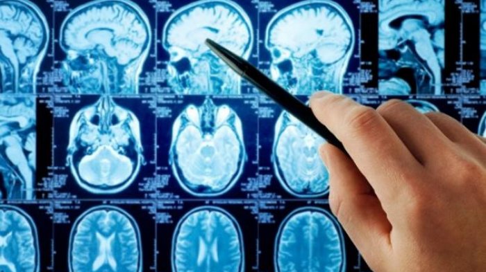 EE.UU: Confirman caso de rara ameba que infecta y destruye el cerebro