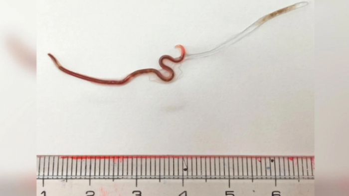 Sushi del terror: Encuentran un gusano vivo en garganta de una mujer