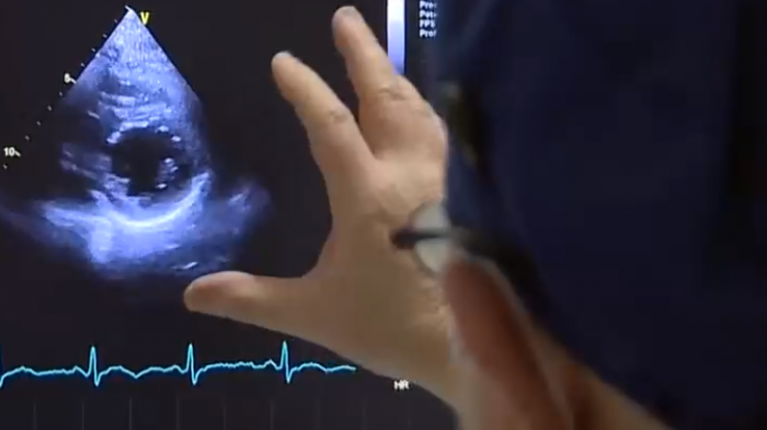 COVID-19 genera problemas al corazón incluso tras alta médica: Hasta 20% de pacientes puede sufrir afecciones cardíacas