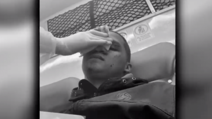 Quedó con 16 puntos y casi pierde la visión de un ojo: Motorista sufrió corte en su rostro por hilo curado