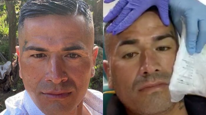 Kike Acuña se puso botox: 