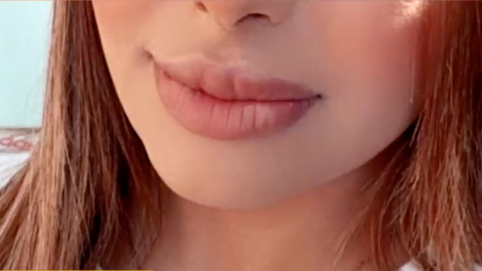 Denuncian a esteticista de Instagram: Jóvenes temen que les hayan inyectado silicona y no ácido hialurónico