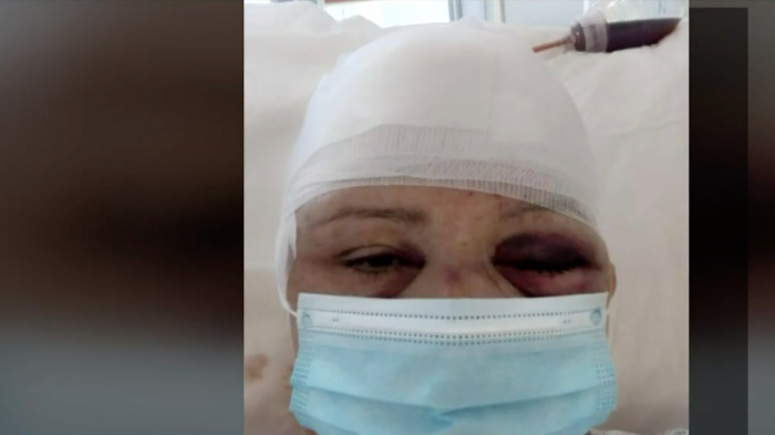 Adulta mayor sufrió grave accidente tras tropezar con scooter: Pide indemnización a empresa