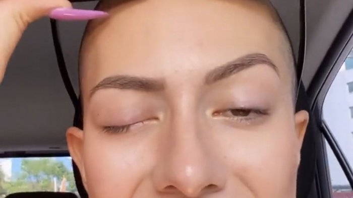 Tiktoker se hizo viral tras quedar con los ojos pegados por confundir pegamento con gotas oculares