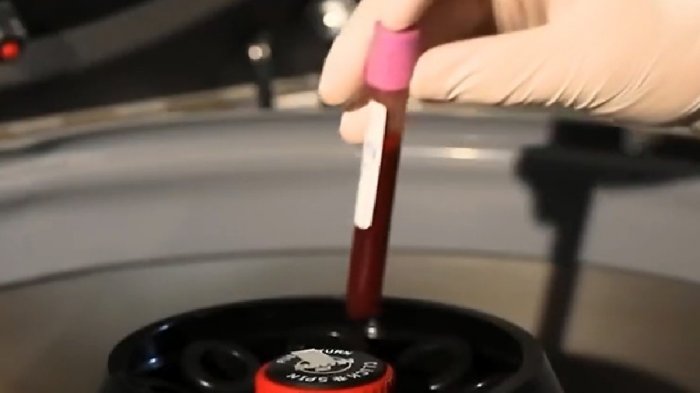 Se realiza sólo en Chile: Examen de sangre causa controversia por prometer detectar el Alzheimer