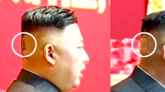 Extraña marca en la nuca de Kim Jong-Un genera nuevos rumores sobre su estado de salud