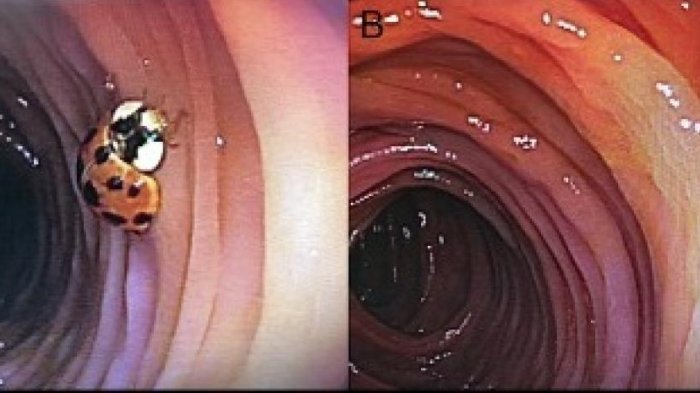 Encuentran insecto viviendo en el intestino de un hombre de 59 años tras colonoscopía