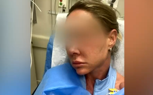 Compró por internet supuestamente ácido hialurónico y sufrió una grave reacción alérgica por el tratamiento