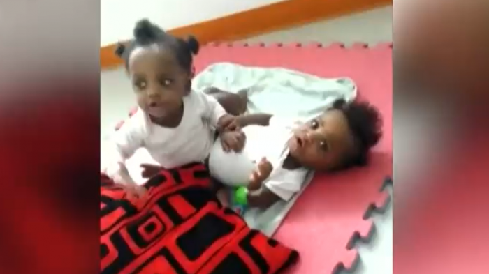 16 horas y 64 profesionales: Siamesas fueron sometidas a exitosa cirugía en Hospital Exequiel González Cortés