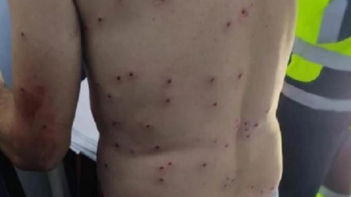 Ciclista fue herido con 100 perdigones: Cazador lo confundió con un conejo