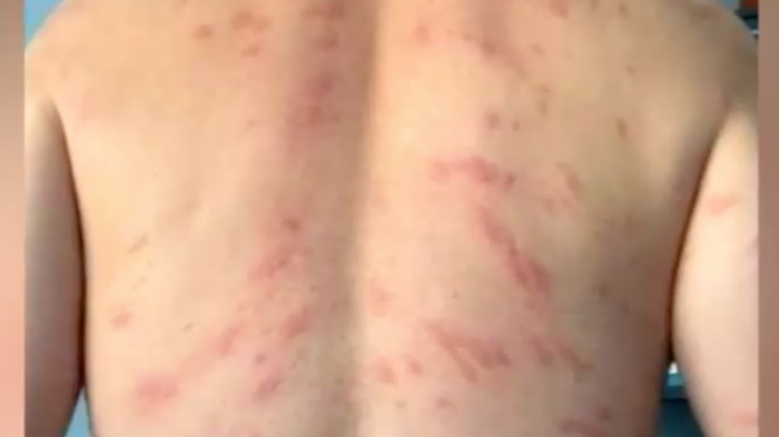 Balneario fue cerrado: Extraña reacción alérgica en laguna de Quillón