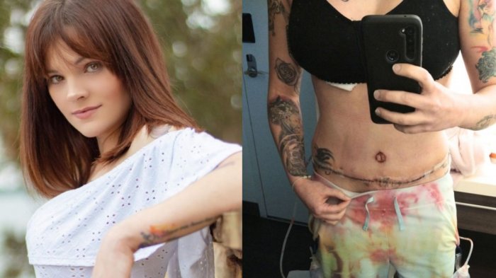 Mujer fue por cirugía para una reducción mamaria: Despertó con implantes y una liposucción