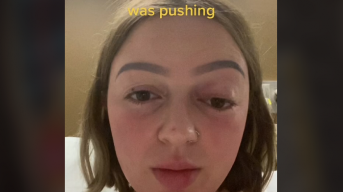 Se le salió un ojo: Mujer se volvió viral al mostrar las consecuencias de pujar tan fuerte mientras daba a luz