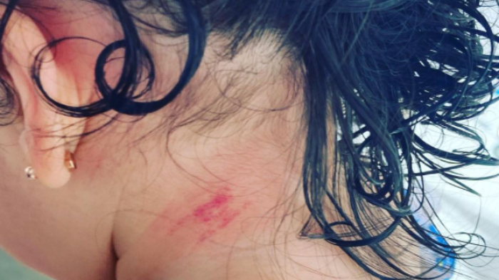 Agua helada y herida en su cuello: Madre denuncia malos tratos hacia guagua de 9 meses en clínica Red Salud