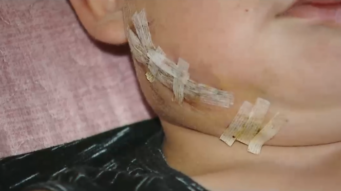 Niño de 6 años quedó gravemente herido tras ataque de dos perros rottweiler